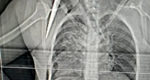 Radiografia de tórax com objeto pontiagudo e alongado atravessando a região do ombro