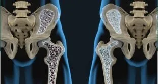 Ilustração médica compara a densidade óssea de dois ossos do quadril