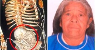 Idosa descobre bebê calcificado em seu ventre e morre após cirurgia