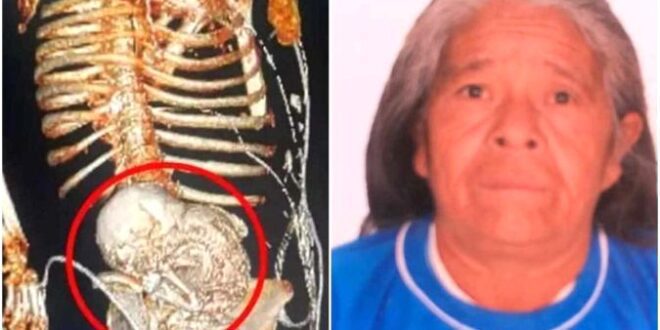 Idosa descobre bebê calcificado em seu ventre e morre após cirurgia