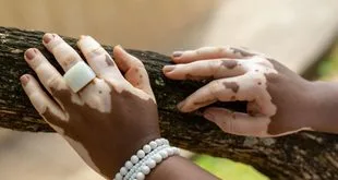 Imagem ilustrativa relacionada a Dia Mundial do Vitiligo