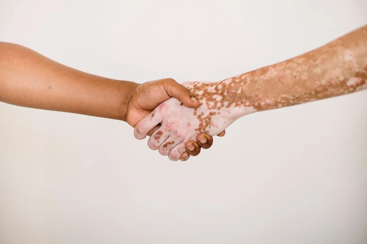 Mãos com manchas de vitiligo na pele, em close