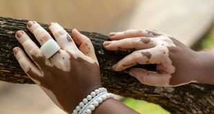 Imagem ilustrativa relacionada a Dia Mundial do Vitiligo