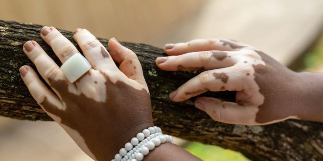 Imagem ilustrativa relacionada a Dia Mundial do Vitiligo