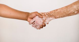 Imagem ilustrativa relacionada a Dia Nacional dos Portadores de Vitiligo