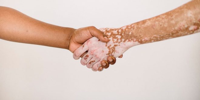 Imagem ilustrativa relacionada a Dia Nacional dos Portadores de Vitiligo