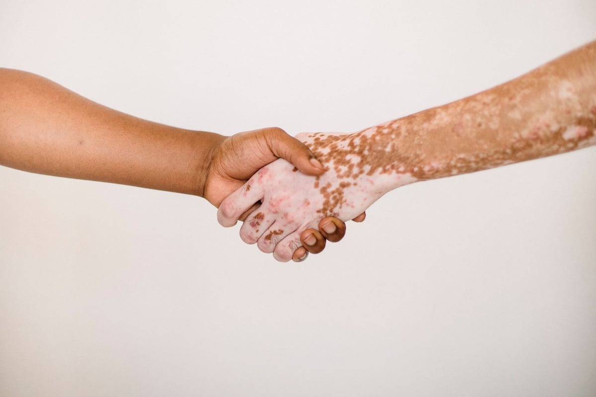 Mãos com manchas de vitiligo na pele, em close